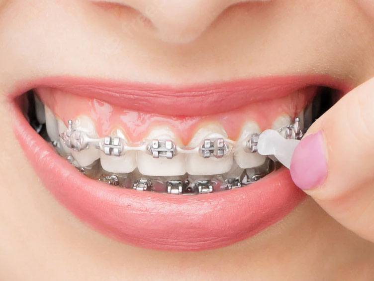 cire orthodontique pour clamer l'irritation