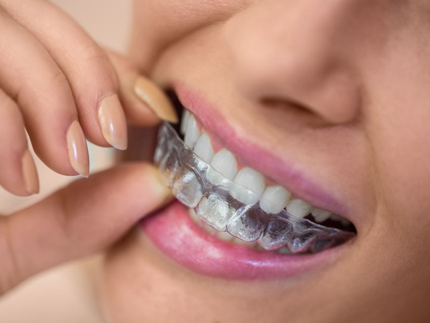 Les aligneurs en orthodontie